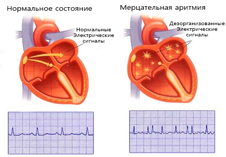 морфологический разбор слова аритмия