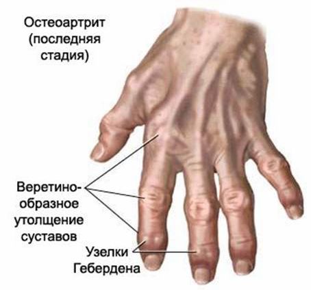 морфологический разбор слова артрит