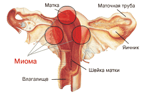 морфологический разбор слова миома